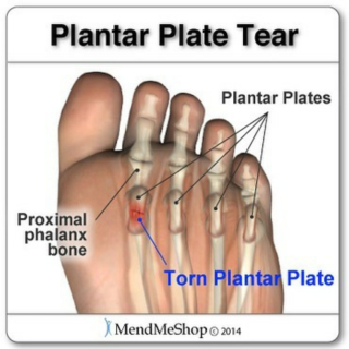 plantar plate tear